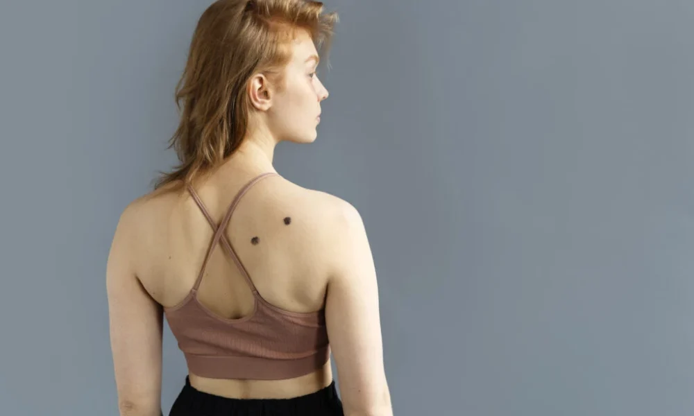 Câncer de pele representa 33% de todos os diagnósticos oncológicos Foto: Freepik